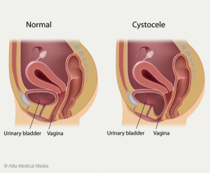 women prolapsed uterus