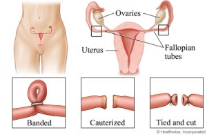 laparoscopic tubal ligation