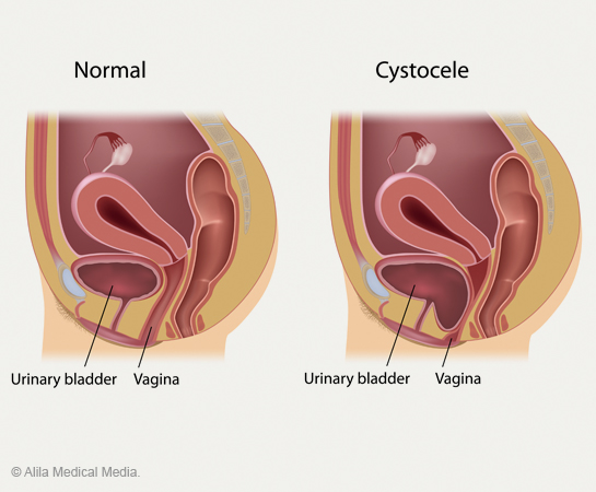 Bowel Incontinence After Prolapse Surgery